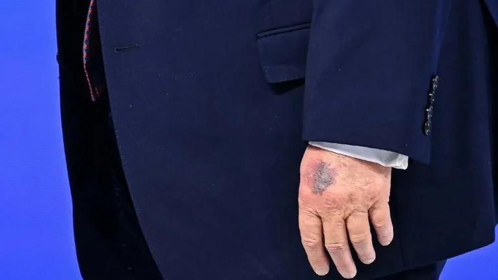 Internationalmedia.co.id - News - Berikut adalah rangkuman lima berita internasional terpopuler hari ini, Jumat (23/1/2026), yang menarik perhatian pembaca. Mulai dari teka-teki memar di tangan Donald Trump hingga penolakan Spanyol terhadap Dewan Perdamaian bentukan AS.
